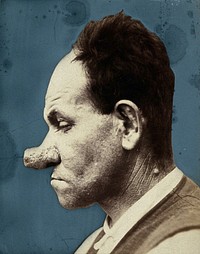 A man with a large, deformed nose diagnosed as caused by hypertrophic acne, in profile. Photograph by Félix Méheux, ca. 1900.