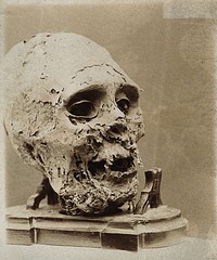 A skull from Peru, with extensive caries or flaking decoration. Photograph.