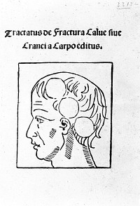 Tractatus de fractura calve sive cranei / a Carpo editus.