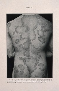 Areas of psoriasis on the back of a thirty year old man. Process print after a photograph, ca. 1905.