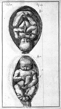 An essay towards a complete new system of midwifry, theoretical and practical. Together with the descriptions, causes and methods of removing, or relieving the disorders peculiar to pregnant ... women, and new-born infants / [John Burton].