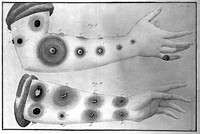 Trattato di vaccinazione con osservazioni sul giavardo e vajuolo pecorino / Del dottore Luigi Sacco ... Con quattro tavole miniate.