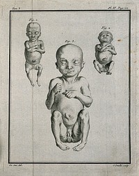 Three figures of foetuses with hermaphroditic genitals. Engraving by J. Daullé after J. de Sève, 1749.