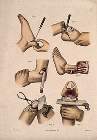 Surgical operations on the foot, ankle and knee: six figures. Coloured lithograph by M. Hanhart after C. Heath after J.B. Léveillé.