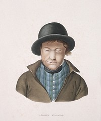 An Icelandic man with leprosy. Coloured engraving by A. Tardieu after L. Bévalet.