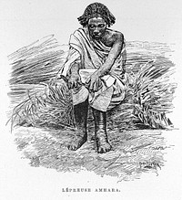 Image of leper in J. Borelli's "Ethiopie meridionale"