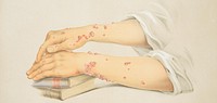 Hands and forearms showing herpes iris. Image of a lithograph from Hebra's Atlas, pt. 6, pl. 6, showing a young woman's hands and forearms, her right on top of her left, resting over a couple of books, displaying herpes iris lesions. Original public domain image from Flickr