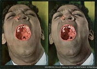 Cicatrices palati mollis post ulcerationes syphiliticas. Stereographies of a man with his mouth wide open to show a circumscribed or diffused gummatous infiltration of the soft palate, that occurs in the tertiary stage of syphilis. Stereoscopic skin clinic. Original public domain image from Flickr