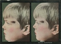 Naevus pigmentosus. Stereographies of a boy's side view with a pigmentary mole by his left eye. Stereoscopic skin clinic. Original public domain image from Flickr