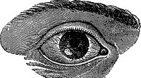 Fig. 34. Phlyctenular Keratitis is characterized by phlyc- tenules in the superficial layers of the coraea like those in phlyctenular conjunctivitis. These phlyctenules appear as inflammatory nodules, singly or in groups, on any-psLTt of the cornea, but most often at the margin.