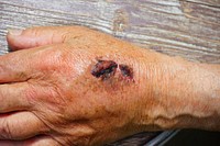 Wound on hand. Free public domain CC0 photo.