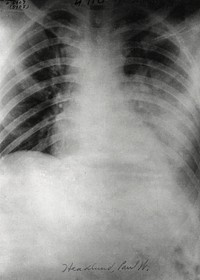 Chest X&ndash;ray of patient with influenza during World War I. Original image from National Museum of Health and Medicine. Digitally enhanced by rawpixel.