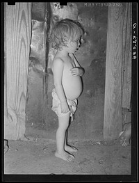 Child of agricultural day laborer living near Tullahassee, Oklahoma. Notice the distended stomach, which is indicative of malnutrution and unbalanced diet with too many starchy foods. This condition is prevalent throughout the tenant farmer and day laboring families in Oklahoma by Russell Lee