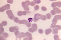 A 1125X photomicrograph magnification of a Giemsa stained, thin film blood smear, revealed a mature, Plasmodium malariae schizont.