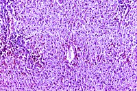 A 100X photomicrograph magnification of photomicrograph of a hematoxylin and eosin (H&E) stained liver tissue specimen, revealed the presence of histopathologic changes indicative of fatty degeneration.