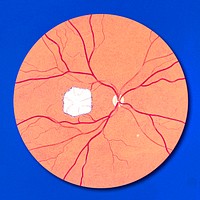 Fundoscopic view of the right eye, it&#39;s optic nerve and blood vessels supplying the retina.