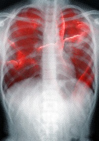 Respiratory tract infection shown on x-ray due to coronavirus 