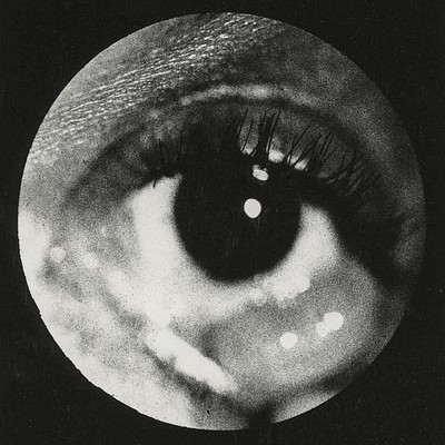 Clinical photograph cyst conjunctiva. Original | Free Photo - rawpixel