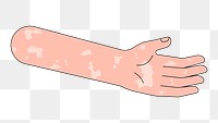 PNG Vitiligo arm hand, body part flat illustration, transparent background