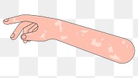 PNG Vitiligo arm hand, body part flat illustration, transparent background