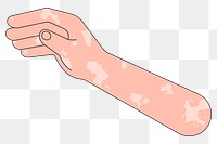 PNG Vitiligo hand arm, gesture flat illustration, transparent background