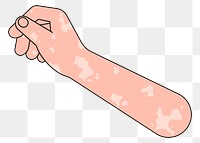 PNG Vitiligo hand arm, gesture flat illustration, transparent background