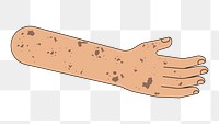 PNG Vitiligo arm hand, body part flat illustration, transparent background