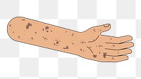 PNG Vitiligo arm hand, body part flat illustration, transparent background