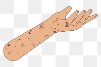 PNG Vitiligo presenting hand, gesture flat illustration, transparent background