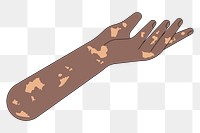 PNG Vitiligo presenting hand, gesture flat illustration, transparent background