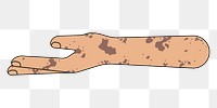 PNG Vitiligo helping hand gesture, flat illustration, transparent background