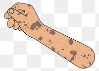 PNG Vitiligo hand arm, gesture flat illustration, transparent background