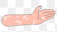 PNG Vitiligo palm hand, gesture flat illustration, transparent background