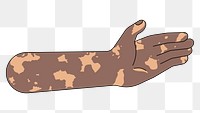 PNG Vitiligo palm hand, gesture flat illustration, transparent background