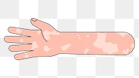 PNG White vitiligo hand arm, gesture illustration, transparent background