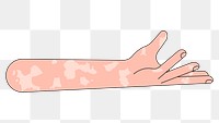 PNG Vitiligo presenting hand gesture, flat illustration, transparent background