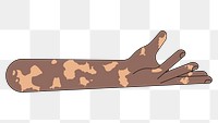 PNG Vitiligo presenting hand gesture, flat illustration, transparent background