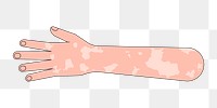 PNG White vitiligo hand gesture, flat illustration, transparent background