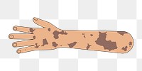 PNG Tanned vitiligo hand gesture, flat illustration, transparent background