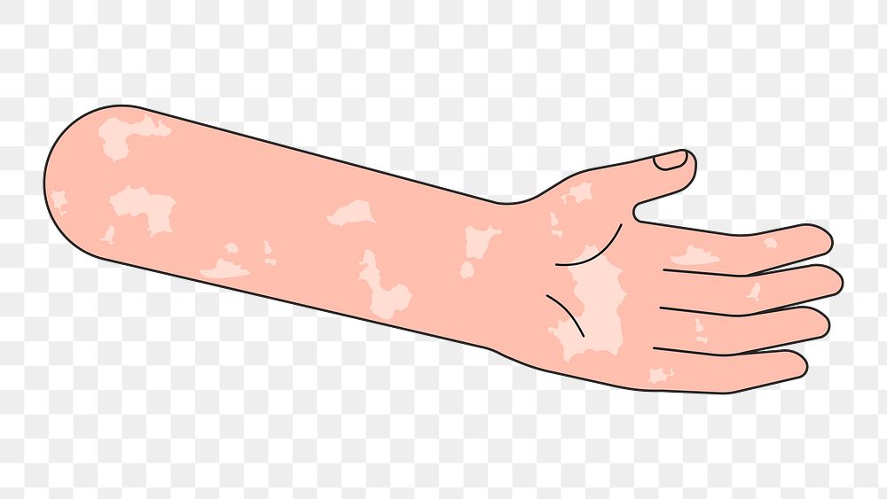 PNG Vitiligo arm hand, body part flat illustration, transparent background