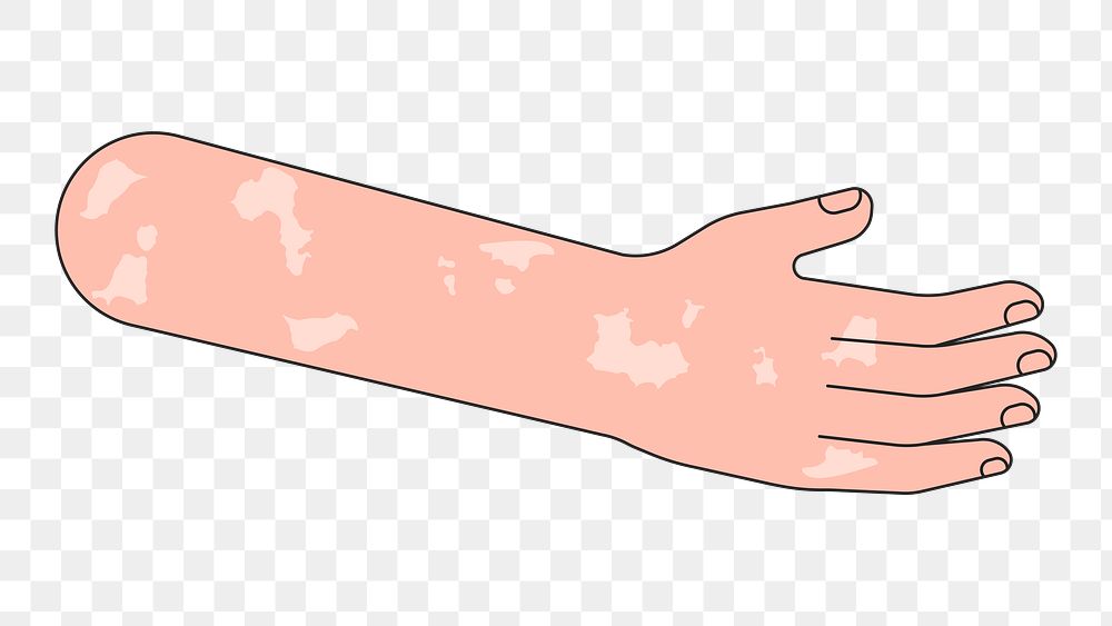 PNG Vitiligo arm hand, body part flat illustration, transparent background