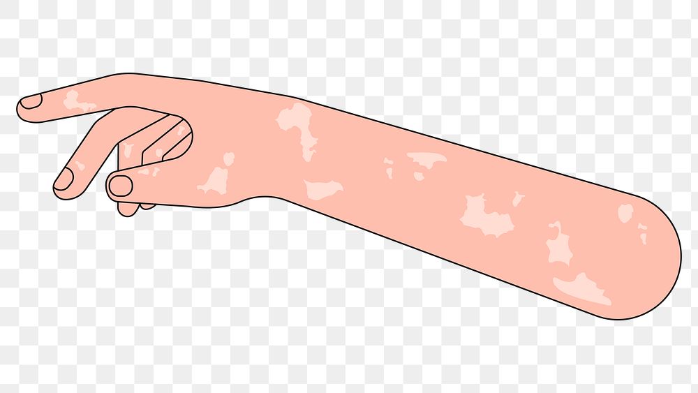 PNG Vitiligo arm hand, body part flat illustration, transparent background