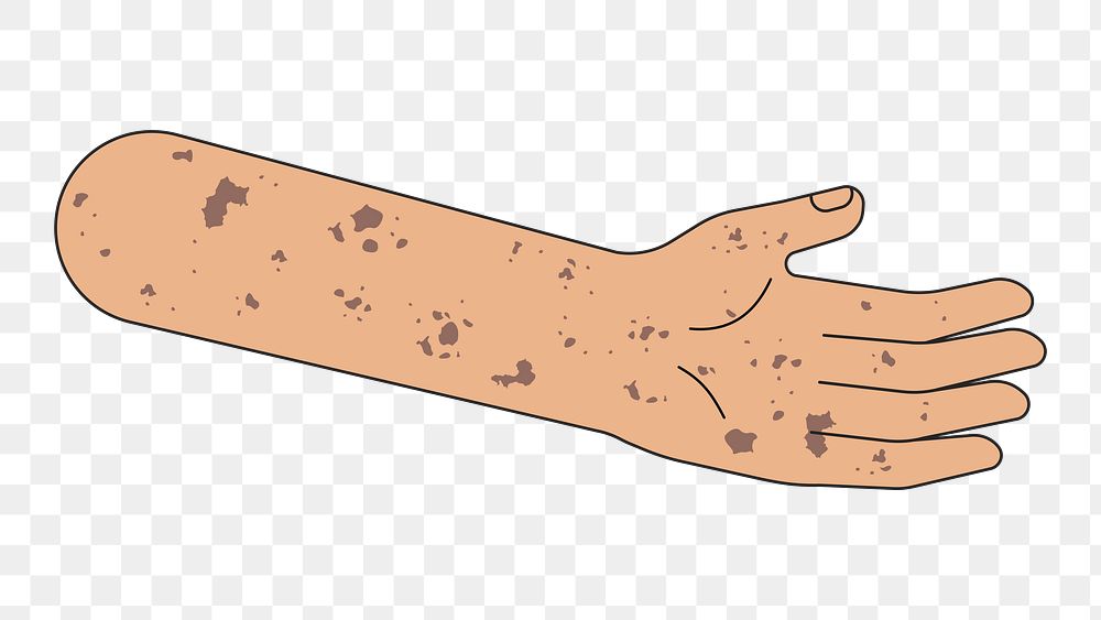 PNG Vitiligo arm hand, body part flat illustration, transparent background