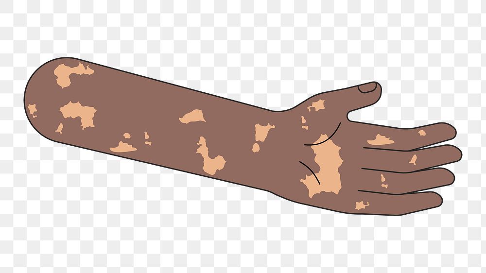 PNG Black vitiligo hand, body part flat illustration, transparent background