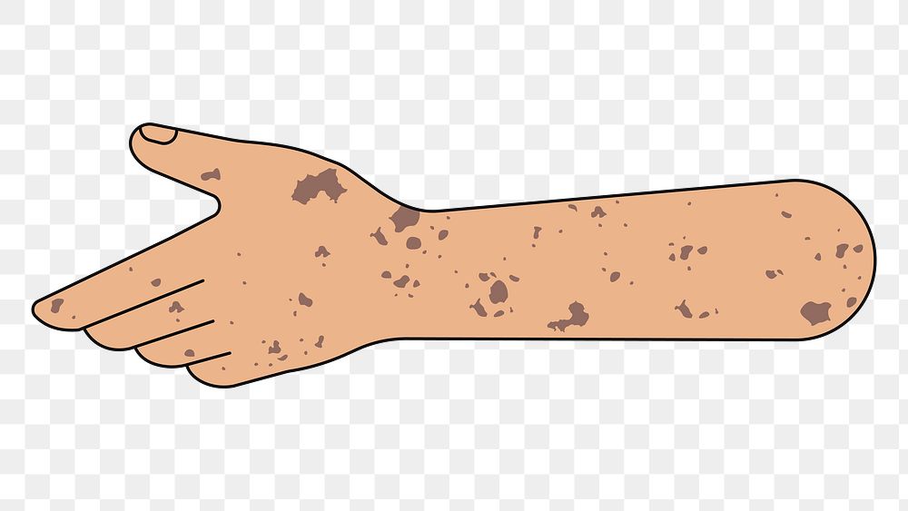 PNG Reaching vitiligo hand, gesture illustration, transparent background