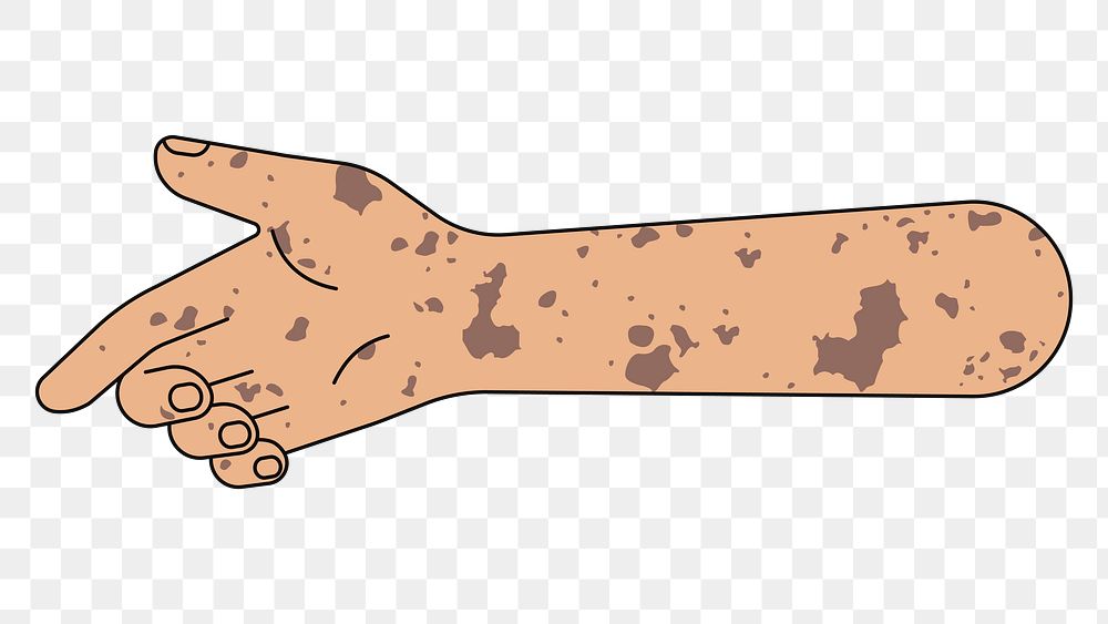 PNG Reaching vitiligo hand, gesture illustration, transparent background