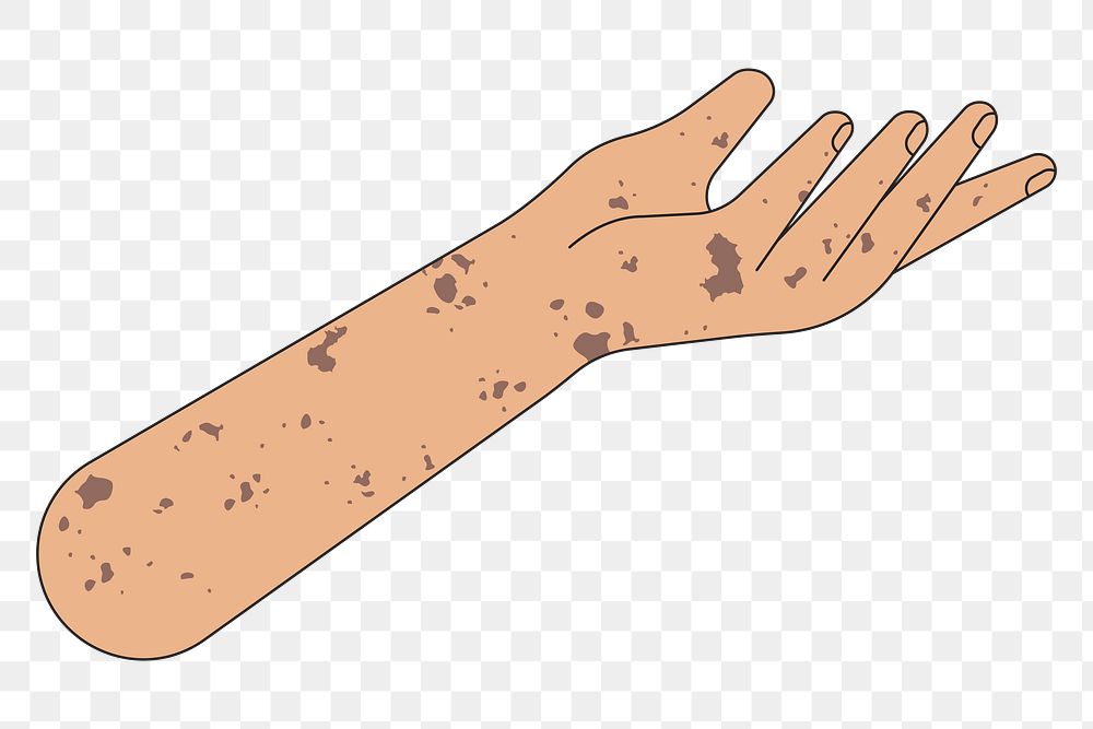 PNG Vitiligo presenting hand, gesture flat illustration, transparent background