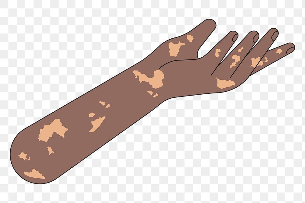 PNG Vitiligo presenting hand, gesture flat illustration, transparent background