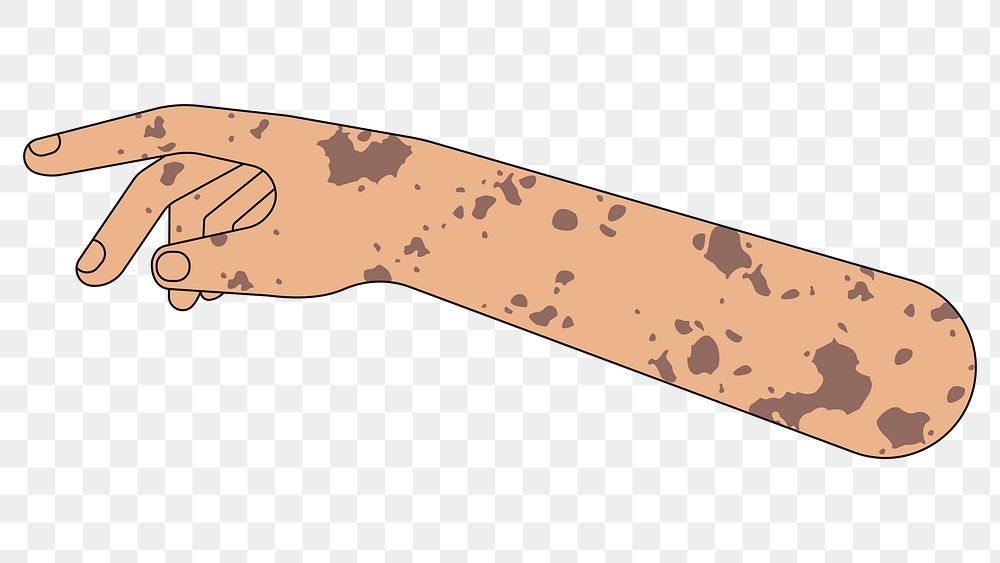 PNG Vitiligo arm hand, body part flat illustration, transparent background