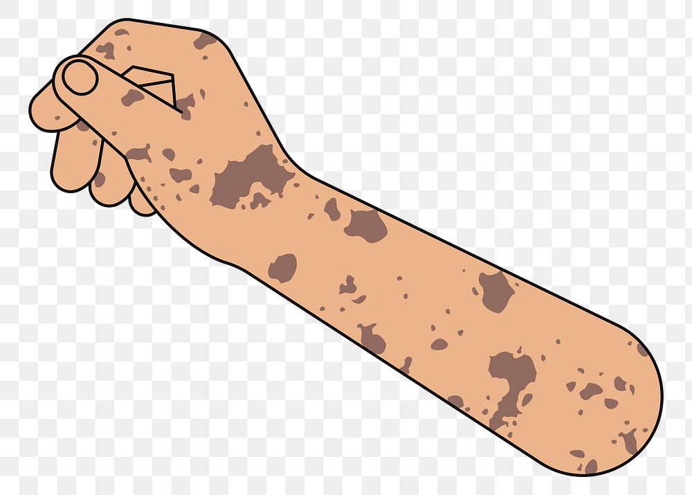 PNG Vitiligo hand arm, gesture flat illustration, transparent background